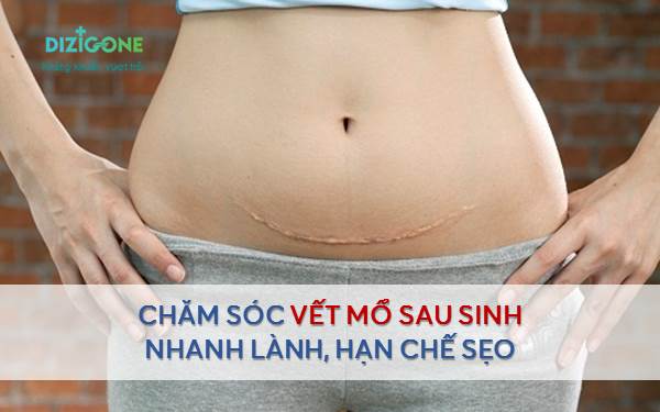 Chăm sóc vết mổ sau sinh nhanh lành và hạn chế sẹo - Dizigone ...