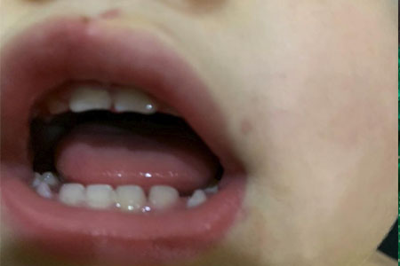 Dizigone giảm sưng viêm nướu răng cắp tính, viêm lợi trùm ở trẻ nhỏ