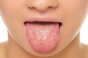 nấm miệng bệnh nhân ung thư