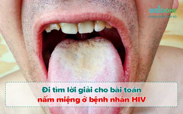 nam-mieng-o-benh-nhan-hiv 1 nấm miệng ở bệnh nhân hiv