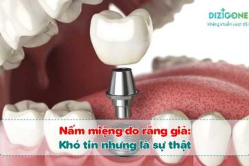 nam-mieng-do-rang-gia nấm miệng do răng giả