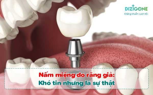 nam-mieng-do-rang-gia nấm miệng do răng giả