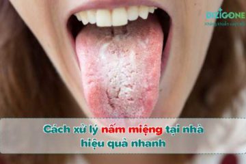 chua-nam-mieng-tai-nha chữa nấm miệng tại nhà