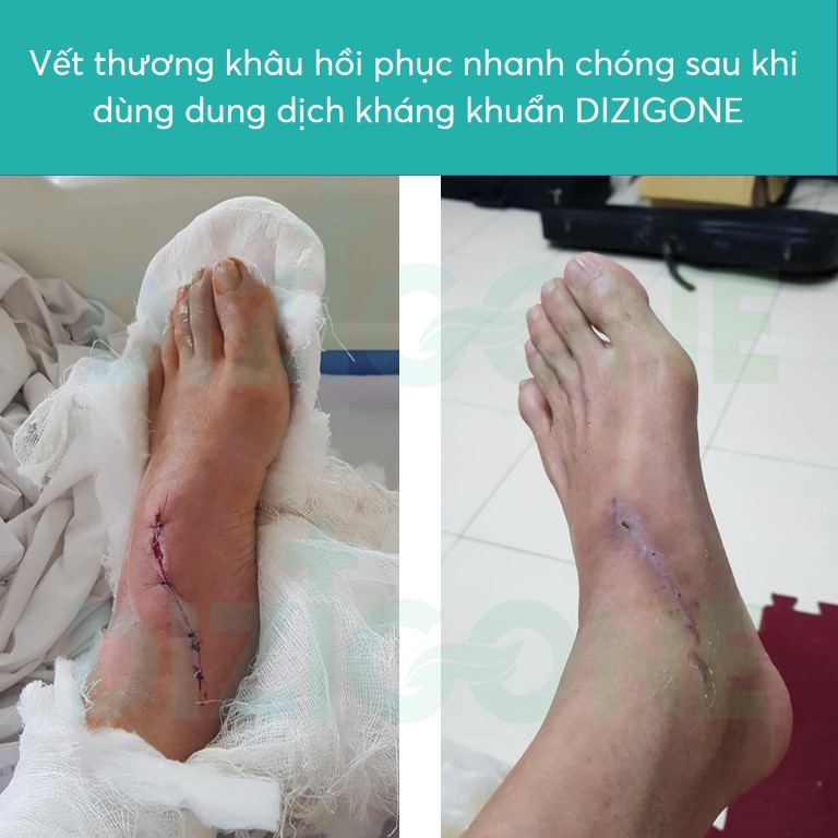 vết thương vet_thuong