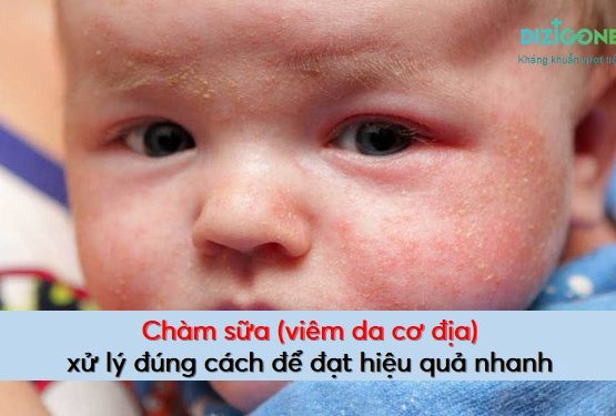 Chàm sữa (viêm da cơ địa): Xử lý đúng cách để đạt hiệu quả nhanh và triệt để Chàm sữa (viêm da cơ địa): Xử lý đúng cách để đạt hiệu quả nhanh và triệt để