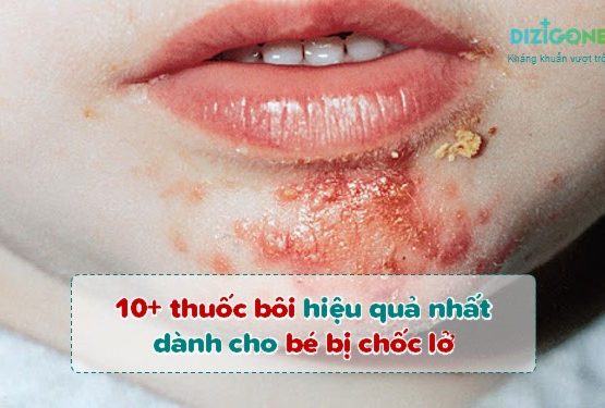 10+ thuốc bôi hiệu quả nhất dành cho bé bị chốc lở 10+ thuốc bôi hiệu quả nhất dành cho bé bị chốc lở