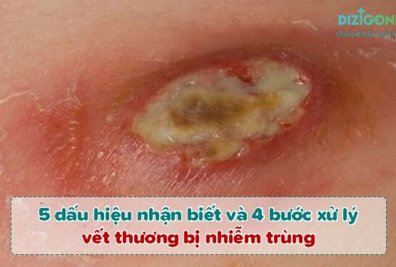 5 dấu hiệu của vết thương bị nhiễm trùng và 4 bước xử lý hiệu quả nhanh 5 dấu hiệu của vết thương bị nhiễm trùng và 4 bước xử lý hiệu quả nhanh