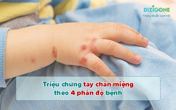 triệu chứng tay chân miệngtrieu-chung-tay-chan-mieng