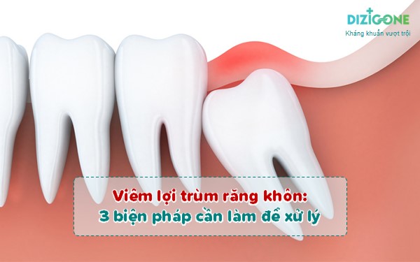 viêm lợi trùm răng khôn viem-loi-trum-rang-khon