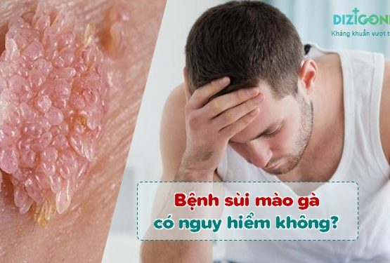 Bệnh sùi mào gà có nguy hiểm không? 4 biến chứng dễ gặp và 3 bước điều trị ngăn ngừa Bệnh sùi mào gà có nguy hiểm không? 4 biến chứng dễ gặp và 3 bước điều trị ngăn ngừa