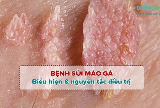 Sùi mào gà: Biểu hiện bệnh và nguyên tắc điều trị để khỏi nhanh Sùi mào gà: Biểu hiện bệnh và nguyên tắc điều trị để khỏi nhanh
