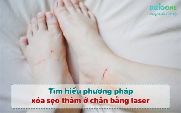 xóa sẹo thâm ở chân bằng laser xoa-seo-tham-o-chan-bang-laser