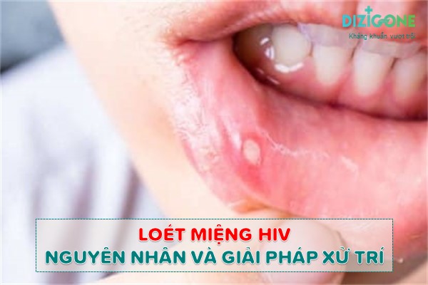 loet-mieng-hiv hoét miệng HIV