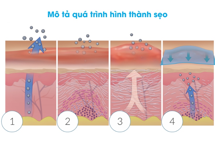 quá trình hình thành sẹo
