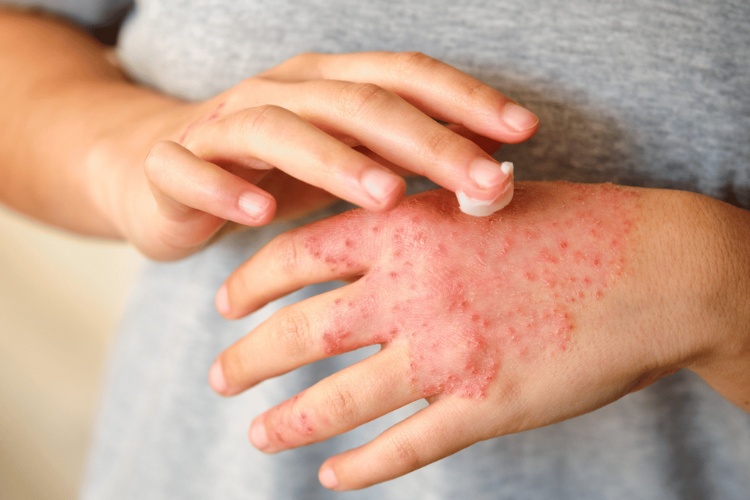 dung dịch hoạt hóa điện hóa và viêm da cơ địa 